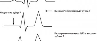 Typical ECG changes in patients with hyperkalemia