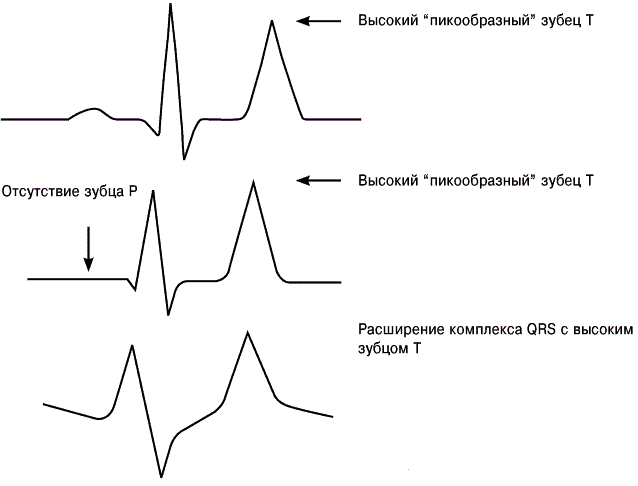 Гиперкалиемия экг картина