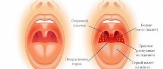 Tonsillitis