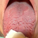 cracks in the tongue in an adult