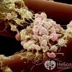 Тромбоциты - кровяные клетки, которые останавливают кровотечение в случае повреждения кровеносного сосуда