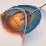 Cataract removal