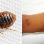 Bedbug bite
