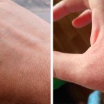 Укус осы у человека фото на руке - что делать, если укусила оса?