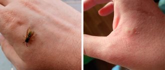 Укус осы у человека фото на руке - что делать, если укусила оса?