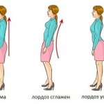 Усиленный и сглаженный лордоз