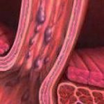 Варикозное расширение вен желудка и пищевода