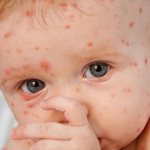 Ветрянка у ребенка
