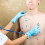 ветрянка у взрослых