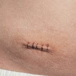 Types of appendicitis