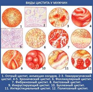 Цистит у мужчин: симптомы и лечение, лекарства от воспаления мочевого ...