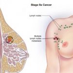 Виды и симптомы опухолей молочной железы у женщин