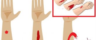 Types of bleeding