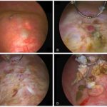 Виды лейкоплакии мочевого пузыря