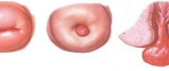 Types of polyps