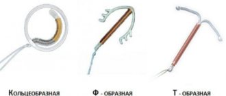 Виды внутриматочных спиралей