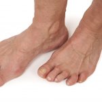 Воспаление суставов