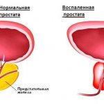 Воспаленная простата у мужчин