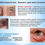 Eversion of the edge of the eyelid