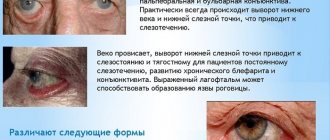 Выворот края века