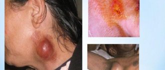 Is tularemia an infectious disease?