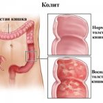 Язвенный колит: симптомы и лечение