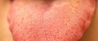 yellow coating on the tongue