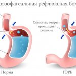 Burning in the sternum in the middle, on the left. Reasons for women: if it’s hard to breathe, belching. What could it be, treatment 